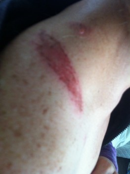 Injury to my shoulder, with a matching one on the other side too :(